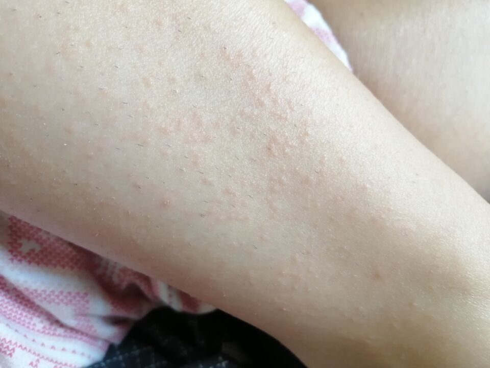 Rash on Elena's legs before using Germivir tablets