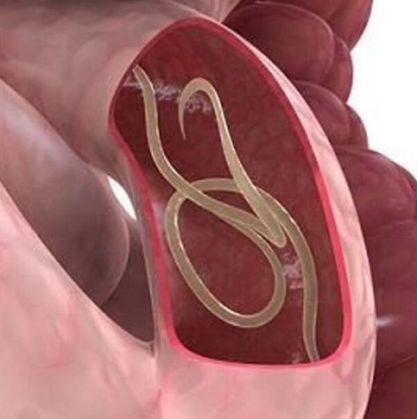 Signs of worms in a person in the stomach -intestine tract